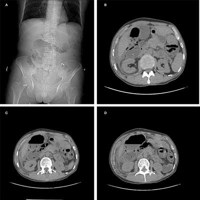 Frontiers Abdominal Cocoon With Intestinal Perforation A Case